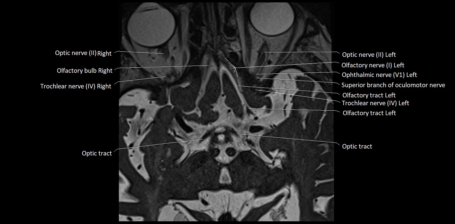 Cranial nerve anatomy axial MRI 3T image 8.webp